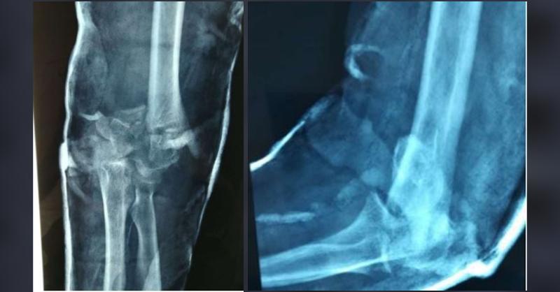 How Will You Manage a Case of Humerus Fracture?