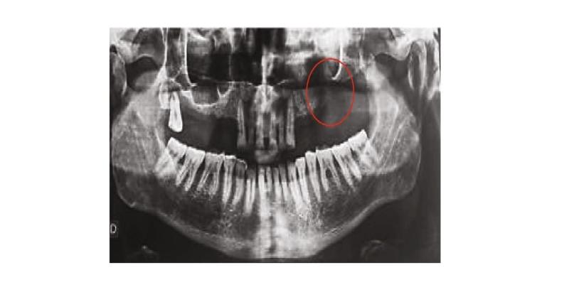 Prosthetic Rehabilitation after Maxillectomy following Squamous Cell Carcinoma