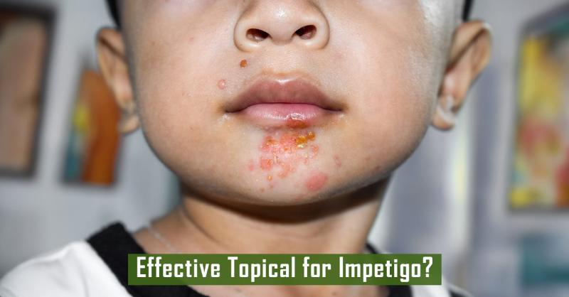 <p>Treatment of Impetigo</p>