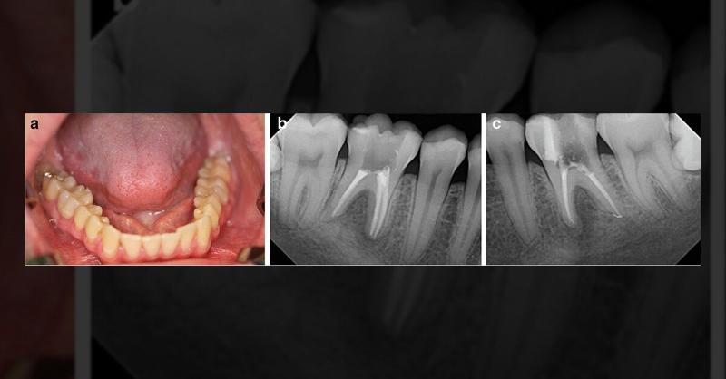 <p>Identifying the Cause of Apical Periodontitis in a Young Adult</p>