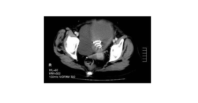 Postmenopausal Woman presenting with Cervical Cancer Symptoms
