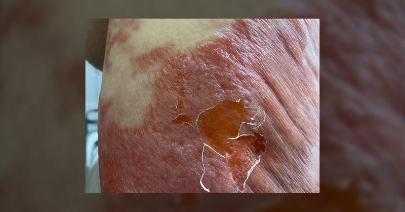 <p>Unusual Rash Presentation in a Chronic Myeloid Leukemia Survivor</p>