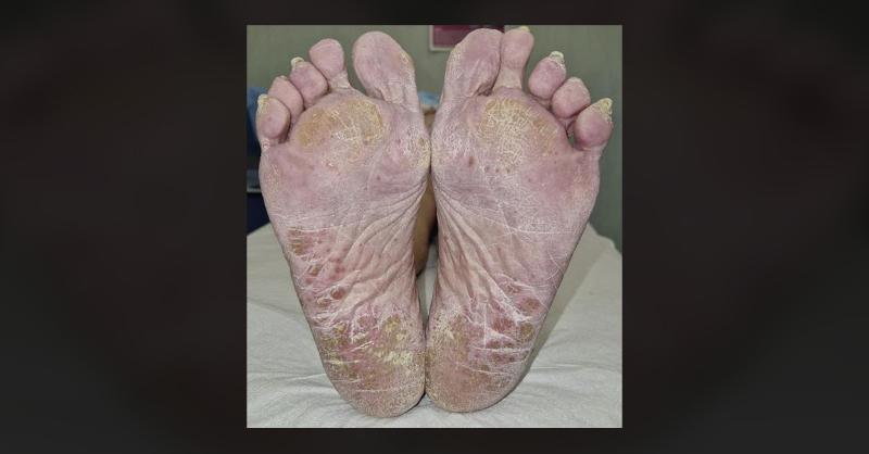 <p>Managing Drug-Induced Psoriasis in Complex Patients</p>
