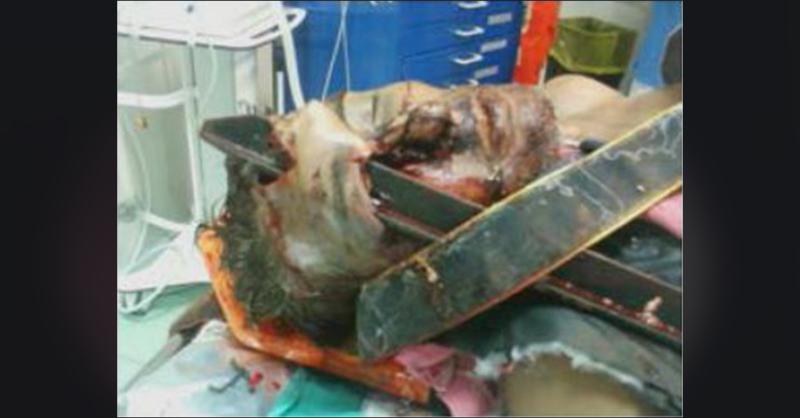 A 42-Year-Old Male With Facial Impaled Trauma