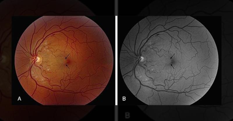 Diagnosis of a Patient with Multiple Cotton Wool Spots and Retinal Hemorrhage