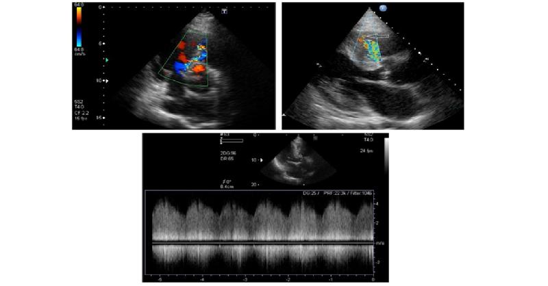 <p>A Patient with Heart Failure Symptoms and Continuous Murmur</p>