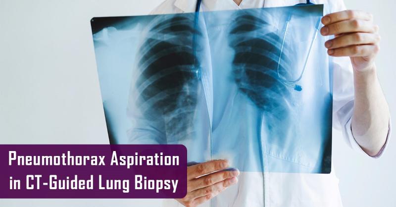 <p>Optimizing Pneumothorax Aspiration Following CT-Guided Percutaneous Transthoracic Lung Biopsy: Impact of Pneumothorax Size and Biopsy Position</p>