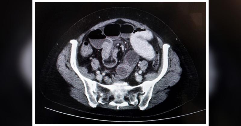 Ileo-Ileal Intussusception in a 60-year-Old Female 