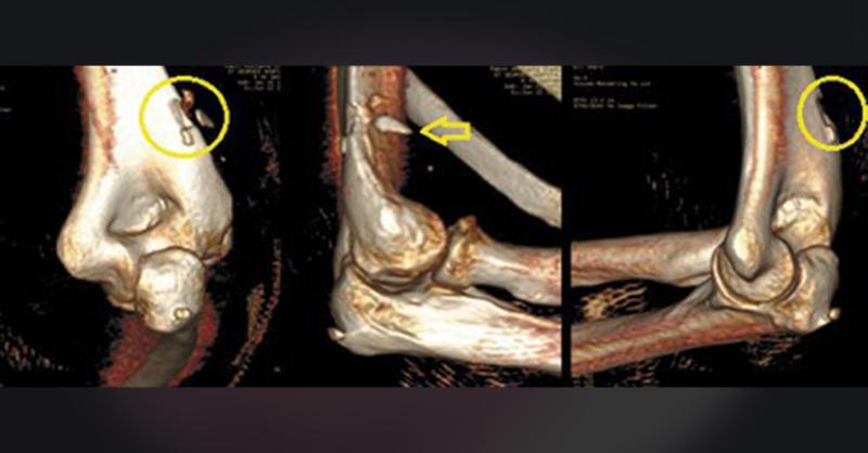 Management of Avulsion Fracture of the Origin of the Brachioradialis Muscle: A rarest case