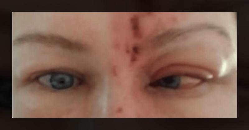 <p>What is the Cause of Abducens Nerve Palsy in this Middle-Aged Woman?</p>
