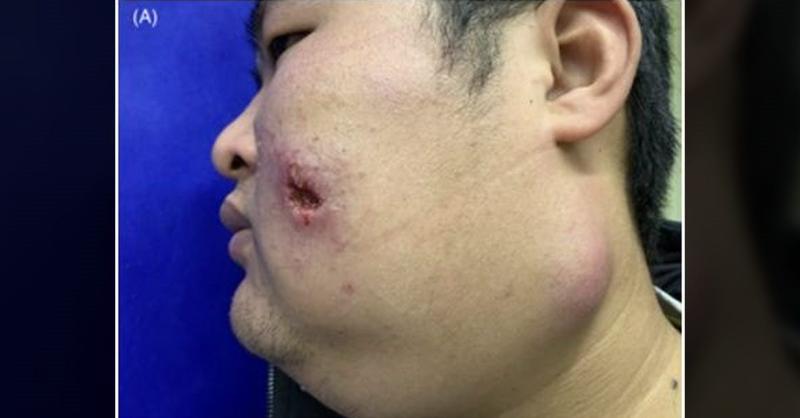 <p>Unusual Presentation of Cutaneous Tuberculosis with Abscess Formation in Mandibular and Submental Region</p>