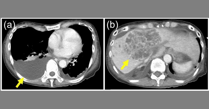 <p>Diagnosis of Liver Abscess and Bacterial Cholangitis in a 67-Year-Old Woman</p>