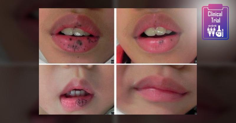 <p>Efficacy of Laser Treatment in Peutz&ndash;Jeghers Syndrome</p>