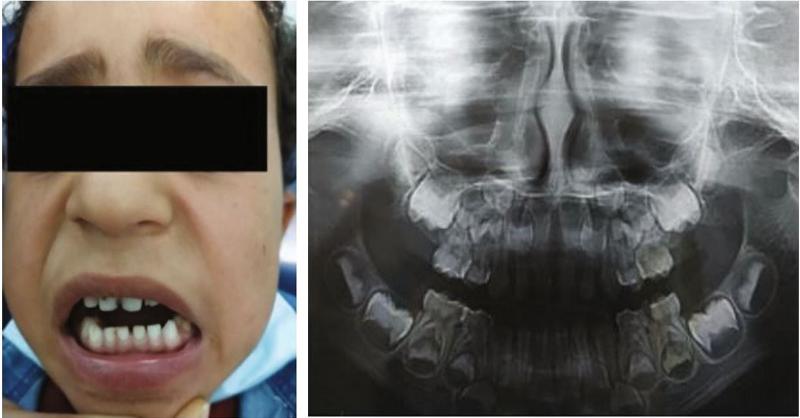 Mandibular deviation and limited mouth opening in a child following facial trauma