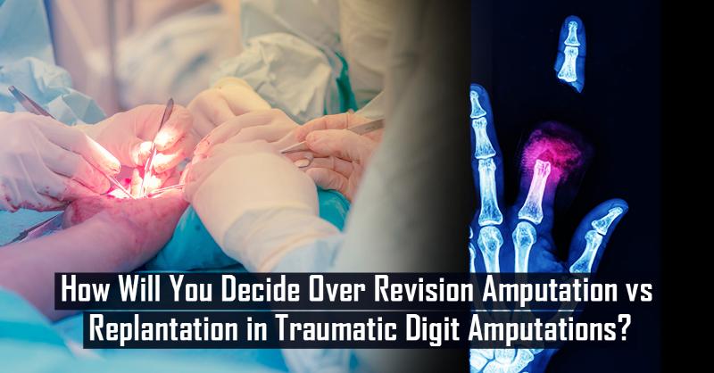 Factors Affecting Choice of Revision Amputation vs Replantation After Traumatic Digit Amputations