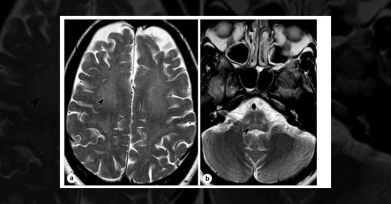 <p>What is the Cause of the Patient&rsquo;s Adult-Onset Progressive Cerebellar Ataxia?</p>