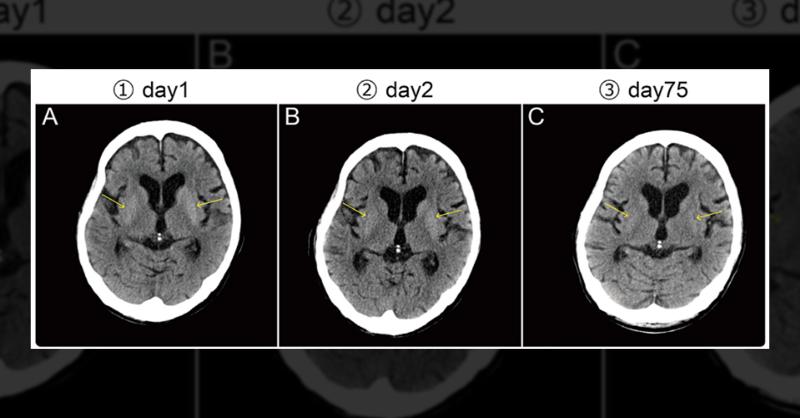 <p>Severe Hyperglycemia in an Uncontrolled Diabetic Elderly Patient</p>