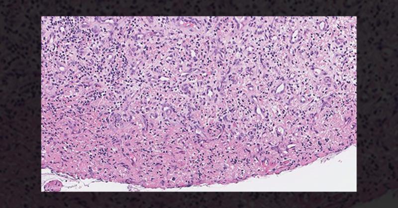 <p>Vocal Cord Polyp in an E-Cigarette User with Progressive Hoarseness</p>