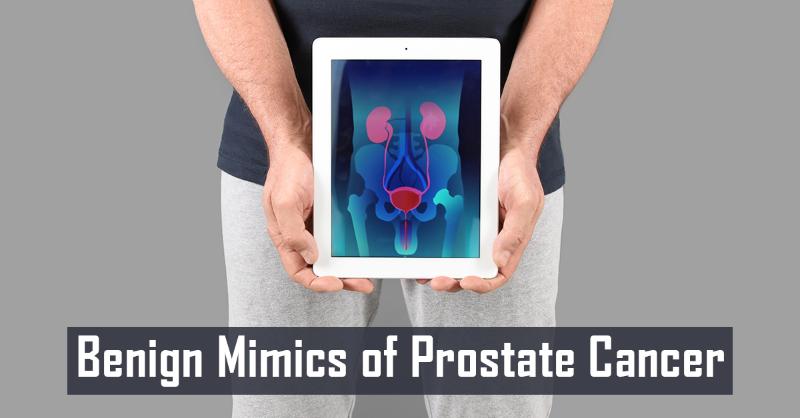 Benign Mimics of Prostate Cancer
