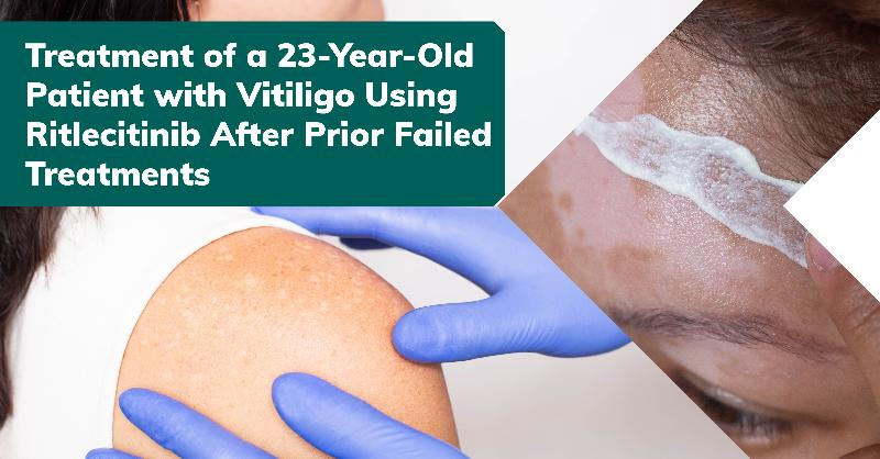 Treating Vitiligo in a Patient After Previous Treatment Failure with Topical Corticosteroids and Calcineurin Inhibitors