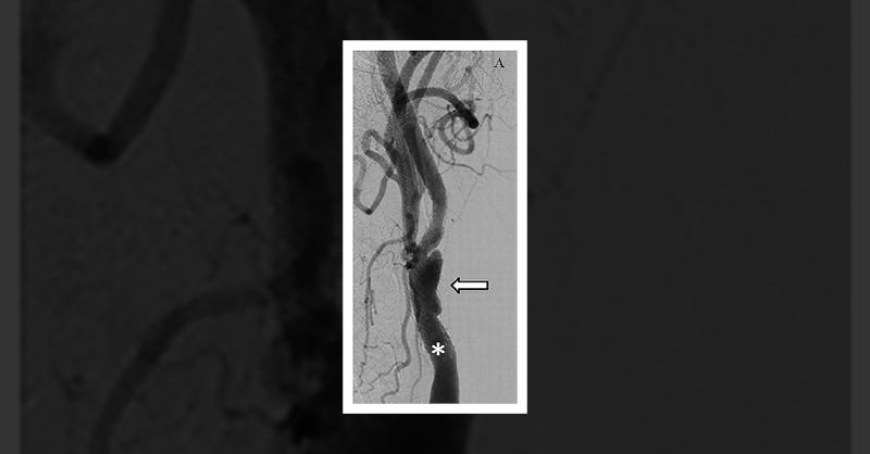 <p>Management of In-Stent Restenosis</p>