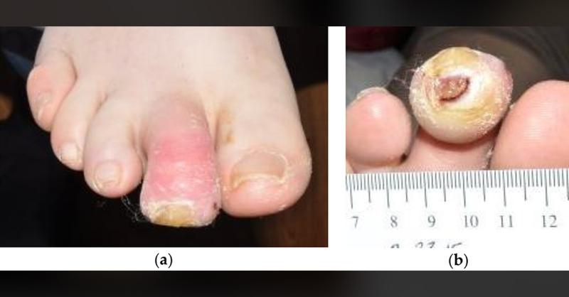<p>Staphylococcal Osteomyelitis: Diabetic Foot Ulcers</p>