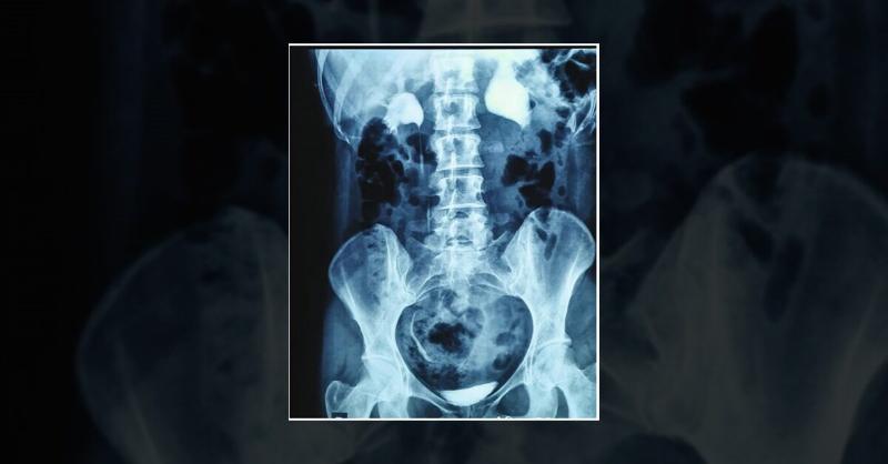 <p>Ureteropelvic Junction Obstruction and Declining Kidney Function in an Adult Woman</p>