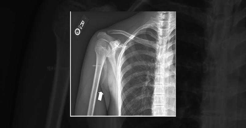 <p>Managing Pectoralis Major Tendon Rupture Caused by Soccer Injury</p>