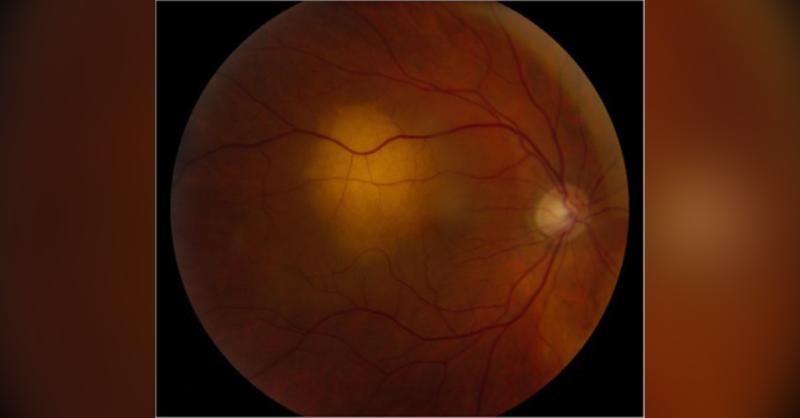 Management of Lung Cancer Induced choroidal Metastatic Lesion