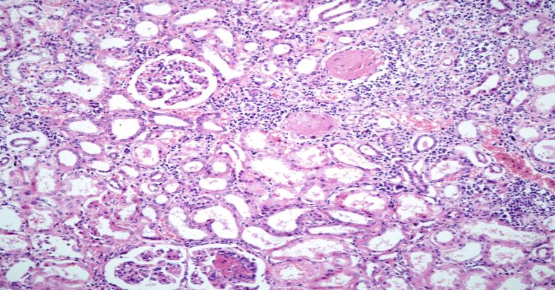 <p>Child with Hypoalbuminemia, Edema, Hyperlipidemia,&nbsp;</p>