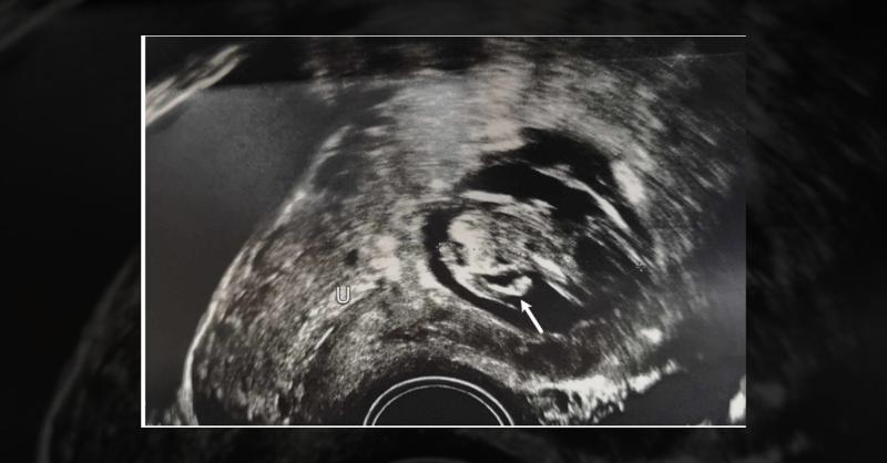 <p>Management of Cesarean Scar Ectopic Pregnancy in a 44-Year-Old Woman</p>