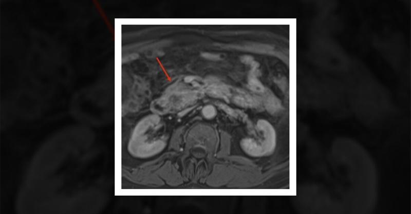 <p>Myeloid Sarcoma Mimicking Pancreatic Mass</p>