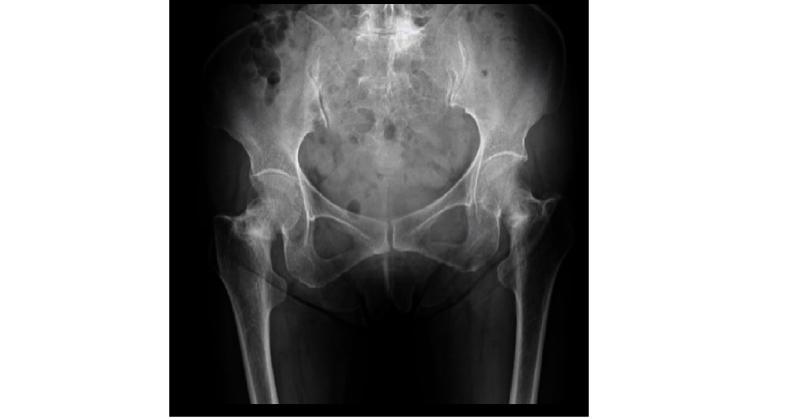 Fractures of Bilateral Femoral Necks in an Older Patient: Atypical Fracture and its Etiology