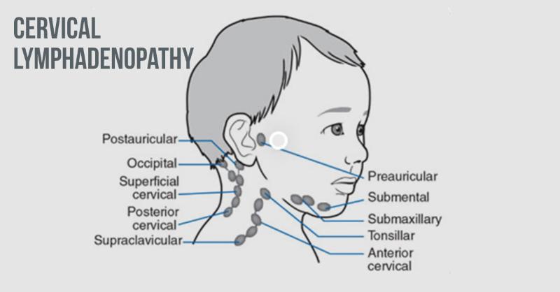 How Significant is Cervical Lymphadenopathy