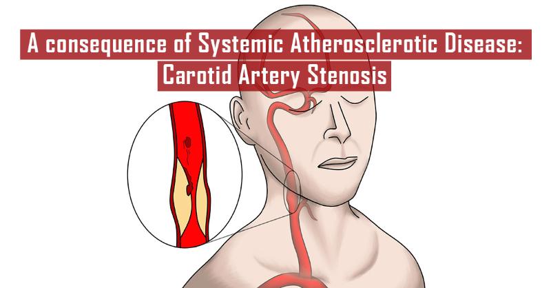 Clinical Guide on Carotid Artery Stenosis