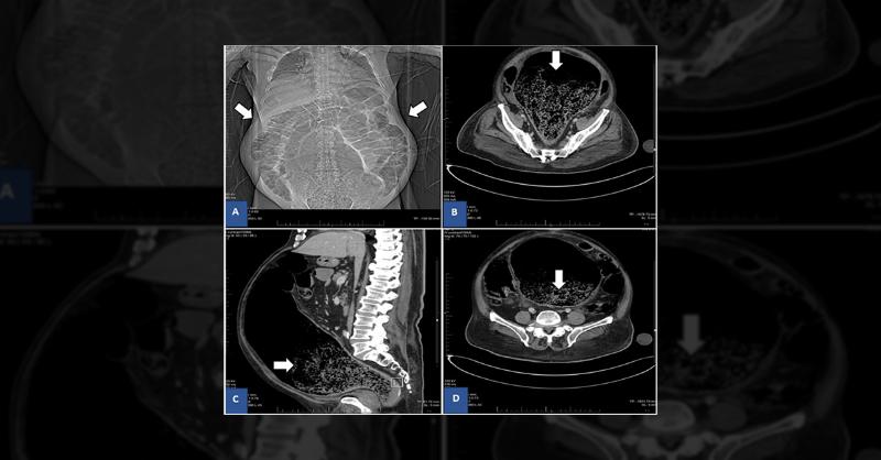 <p>Abdominal Pain and Neurological Findings in an Elderly with Delusional Disorder</p>
